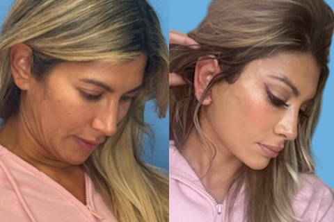 This is a 41 year old 2 weeks after deep plane facelift