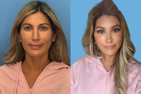This is a 41 year old 2 weeks after deep plane facelift