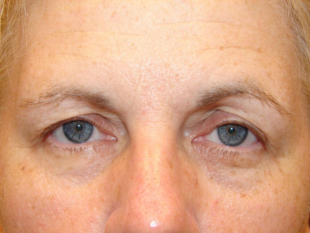 Blepharoplasty Before & After Image