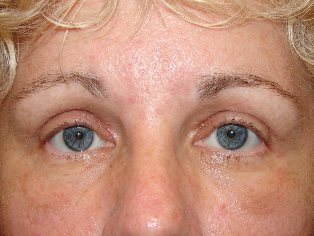 Blepharoplasty Before & After Image