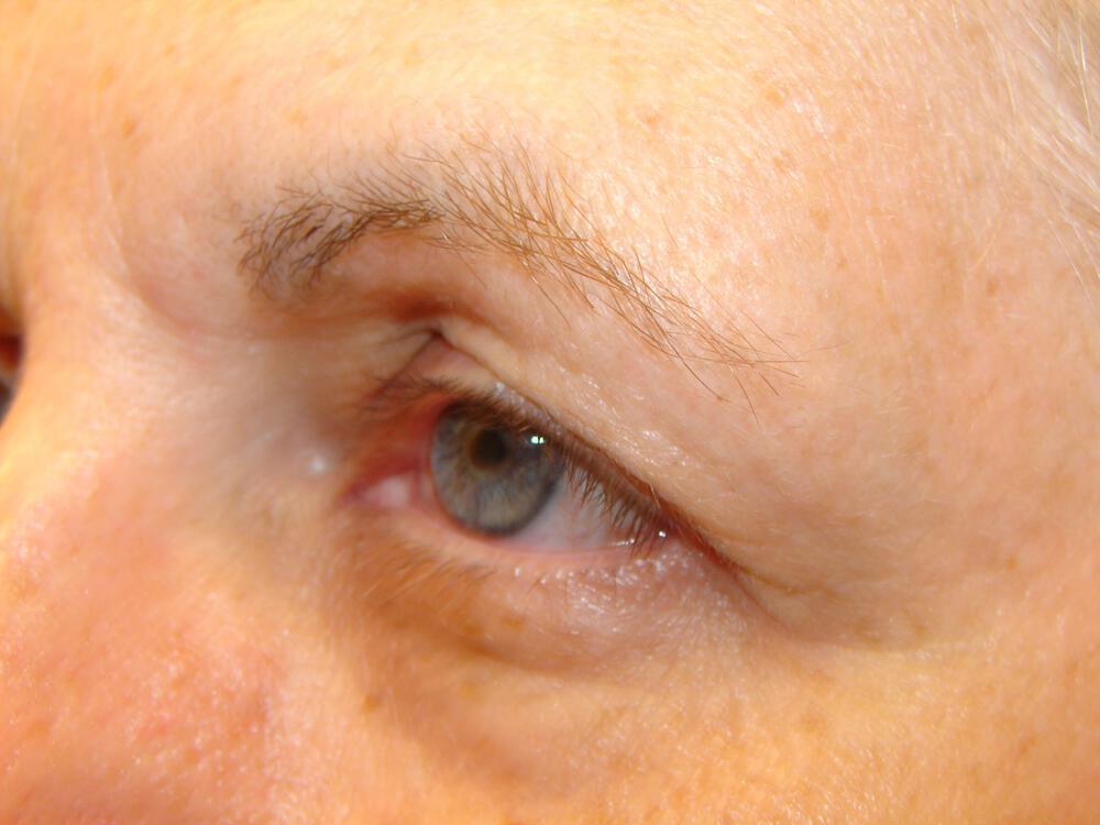 Blepharoplasty Before & After Image