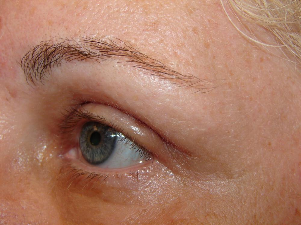 Blepharoplasty Before & After Image