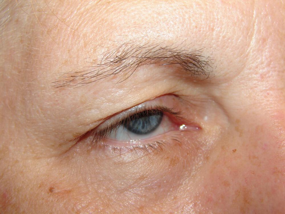 Blepharoplasty Before & After Image