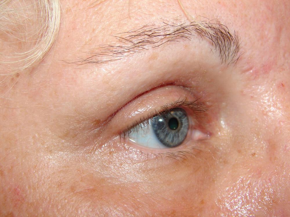 Blepharoplasty Before & After Image