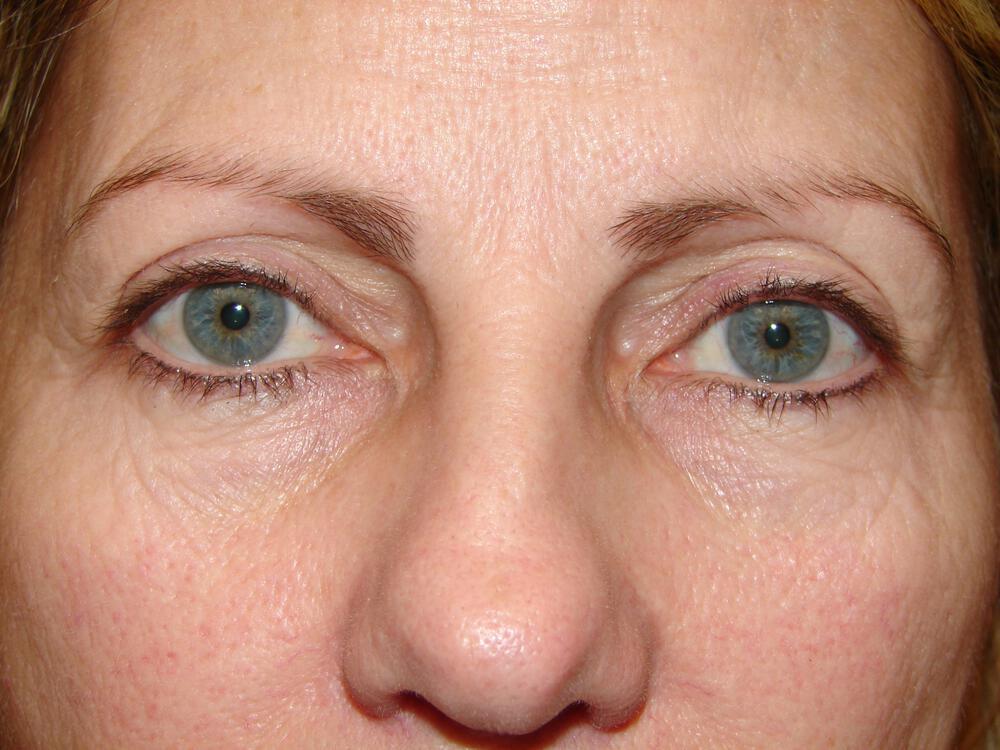 Blepharoplasty Before & After Image