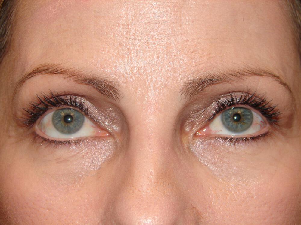 Blepharoplasty Before & After Image