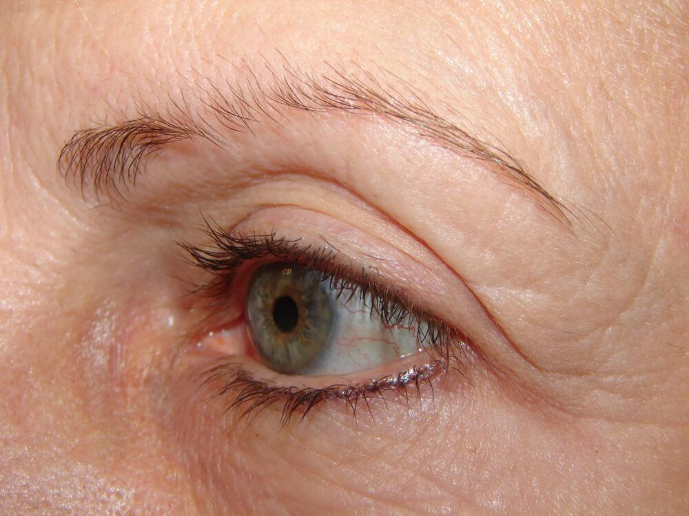 Blepharoplasty Before & After Image