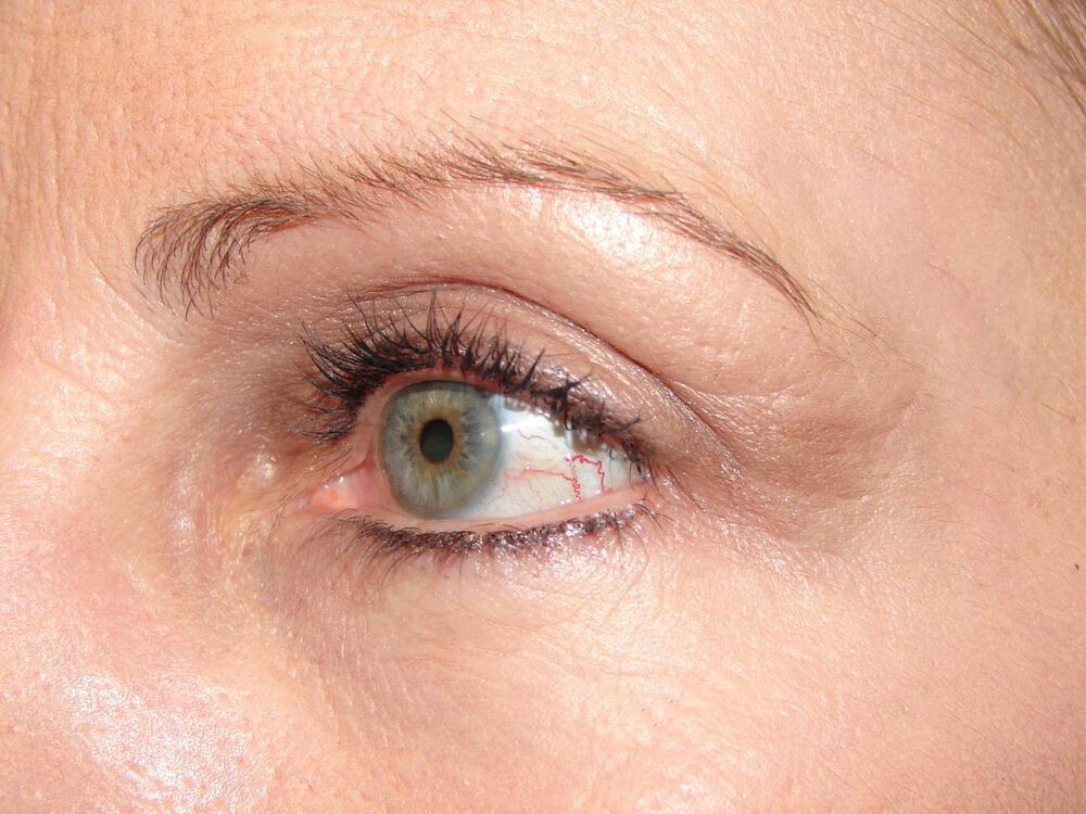 Blepharoplasty Before & After Image