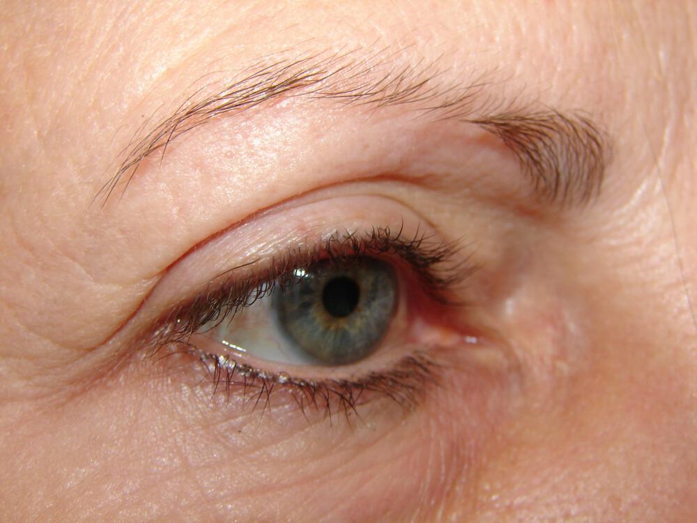 Blepharoplasty Before & After Image