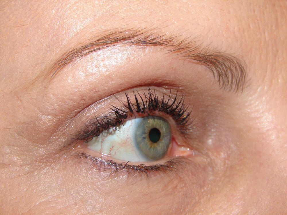 Blepharoplasty Before & After Image