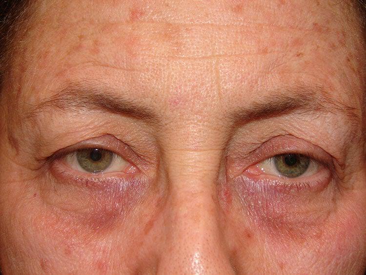 Blepharoplasty Before & After Image