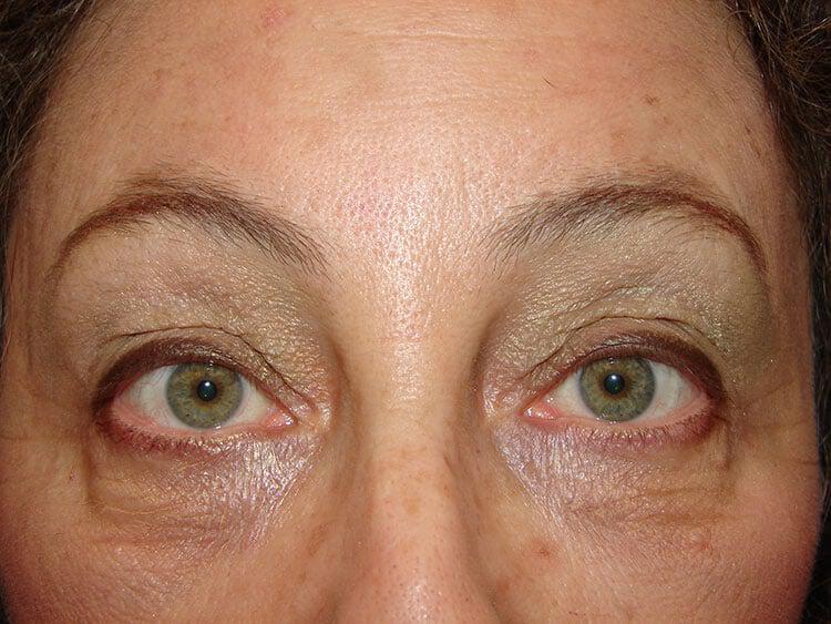 Blepharoplasty Before & After Image