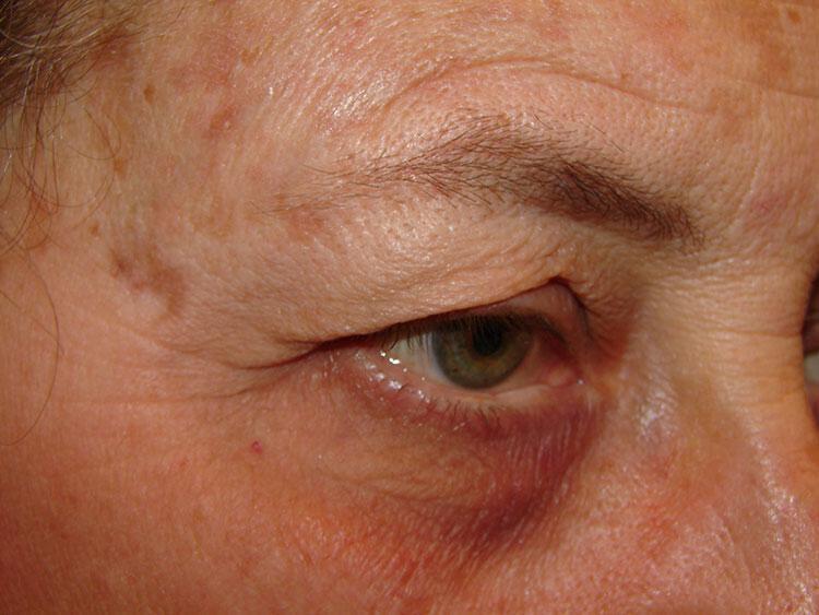 Blepharoplasty Before & After Image