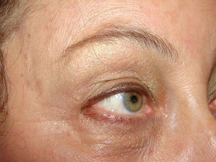 Blepharoplasty Before & After Image