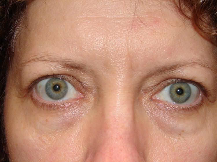 Blepharoplasty Before & After Image