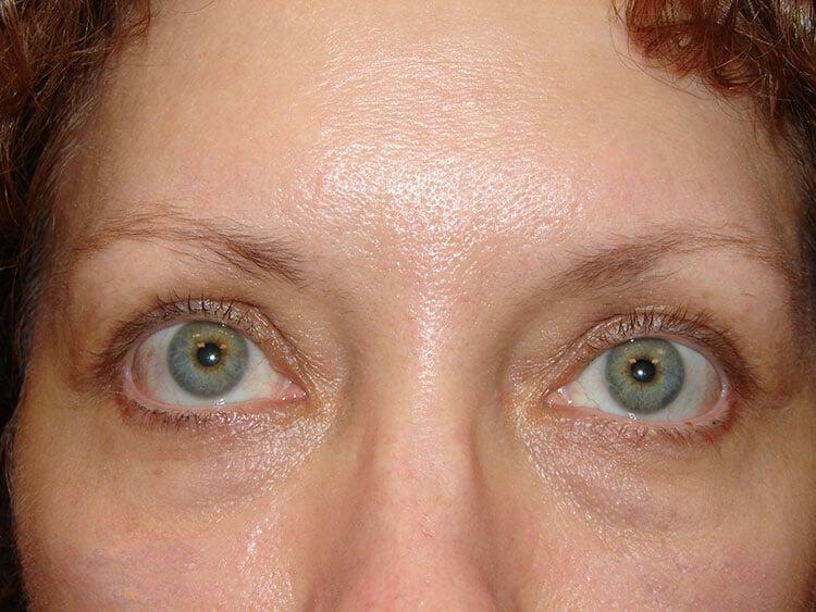 Blepharoplasty Before & After Image