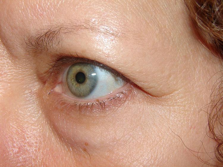 Blepharoplasty Before & After Image