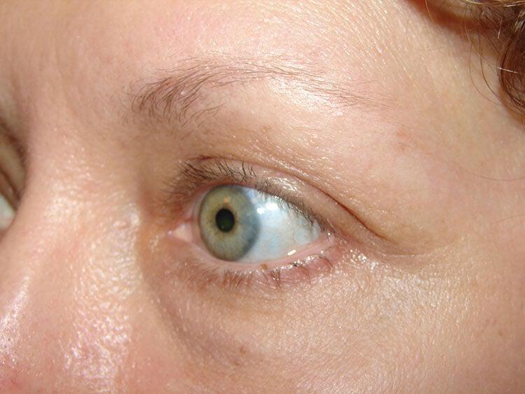 Blepharoplasty Before & After Image