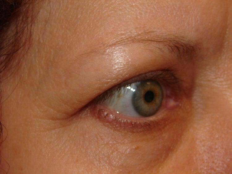 Blepharoplasty Before & After Image