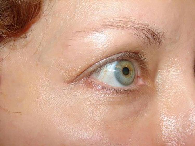 Blepharoplasty Before & After Image