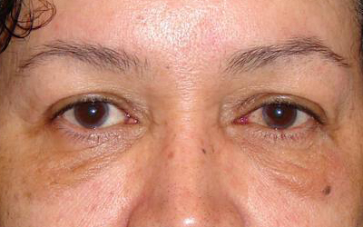 Blepharoplasty Before & After Image