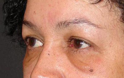 Blepharoplasty Before & After Image