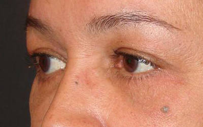 Blepharoplasty Before & After Image