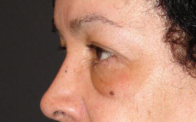 Blepharoplasty Before & After Image