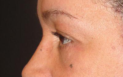 Blepharoplasty Before & After Image