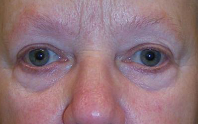 Blepharoplasty Before & After Image