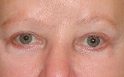 Blepharoplasty Before & After Image