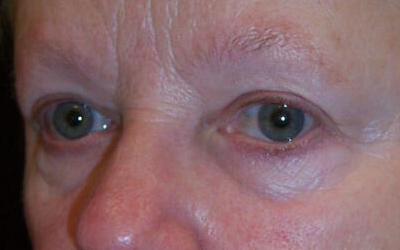 Blepharoplasty Before & After Image