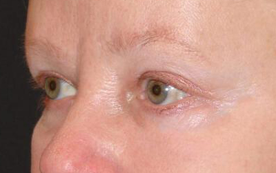 Blepharoplasty Before & After Image