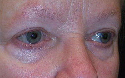 Blepharoplasty Before & After Image