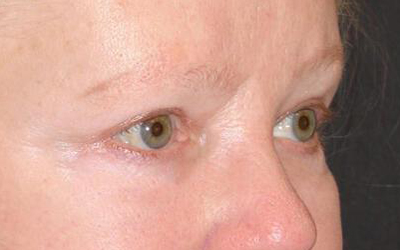 Blepharoplasty Before & After Image