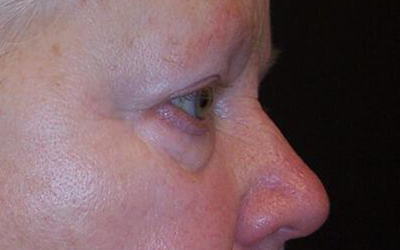 Blepharoplasty Before & After Image