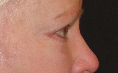 Blepharoplasty Before & After Image