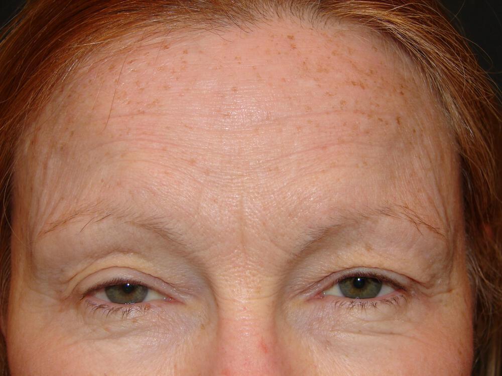 Blepharoplasty Before & After Image