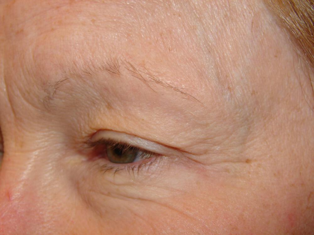 Blepharoplasty Before & After Image