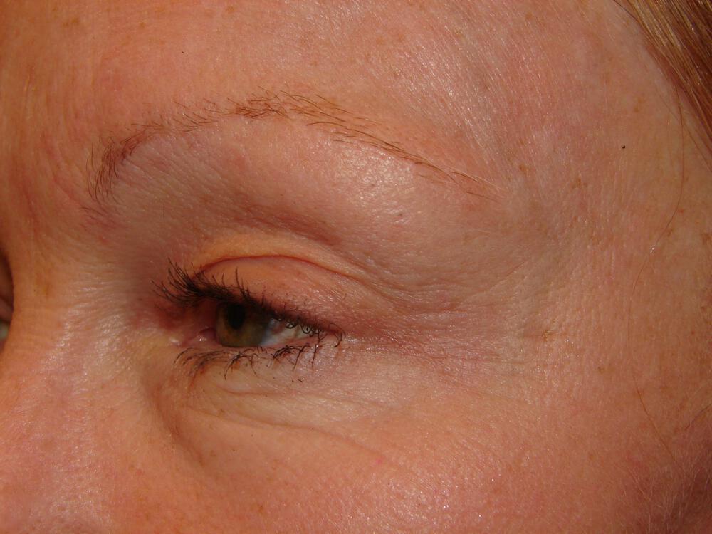 Blepharoplasty Before & After Image