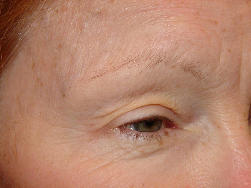 Blepharoplasty Before & After Image