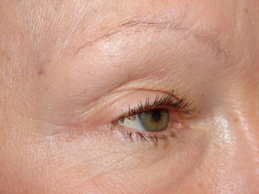 Blepharoplasty Before & After Image