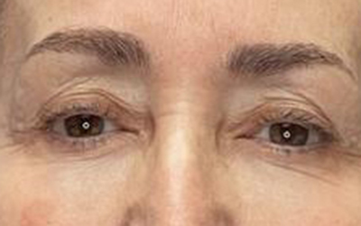 Blepharoplasty Before & After Image