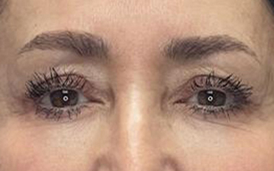 Blepharoplasty Before & After Image