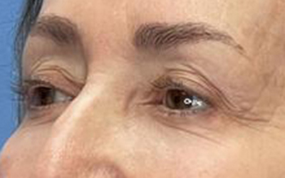 Blepharoplasty Before & After Image