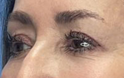 Blepharoplasty Before & After Image