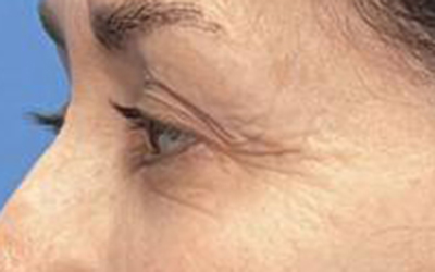 Blepharoplasty Before & After Image