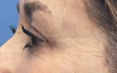 Blepharoplasty Before & After Image