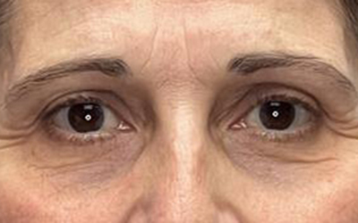 Blepharoplasty Before & After Image