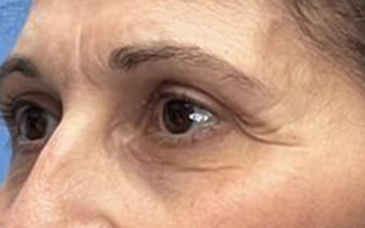 Blepharoplasty Before & After Image